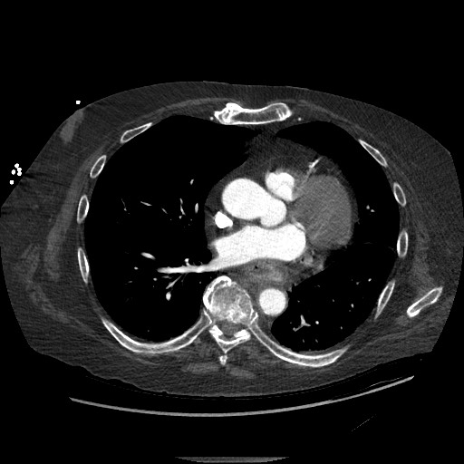 Aortoesophageal fistula with endovascular repair (Radiopaedia 73781-84592 Axial C+ CTPA 93).jpg
