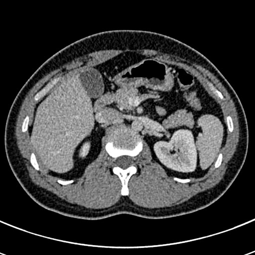 Apical lung mass mimic - neurogenic tumor (Radiopaedia 59918-67521 A 91).jpg