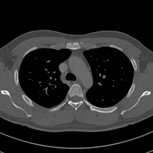 Apical lung mass mimic - neurogenic tumor (Radiopaedia 59918-67521 Axial bone window 27).jpg