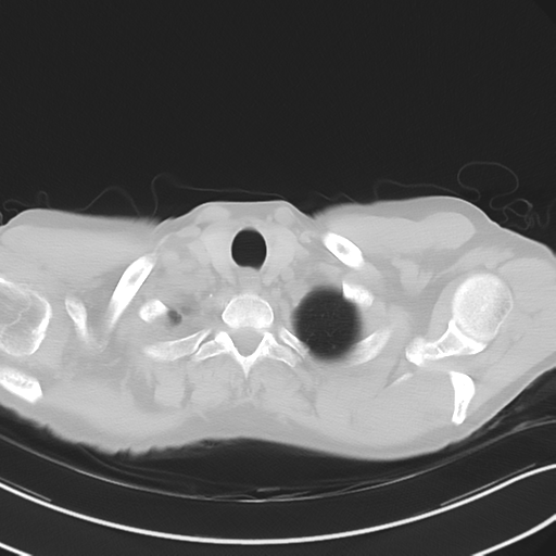 Apical pulmonary metastasis (Radiopaedia 46338-50754 Axial non-contrast 7).png