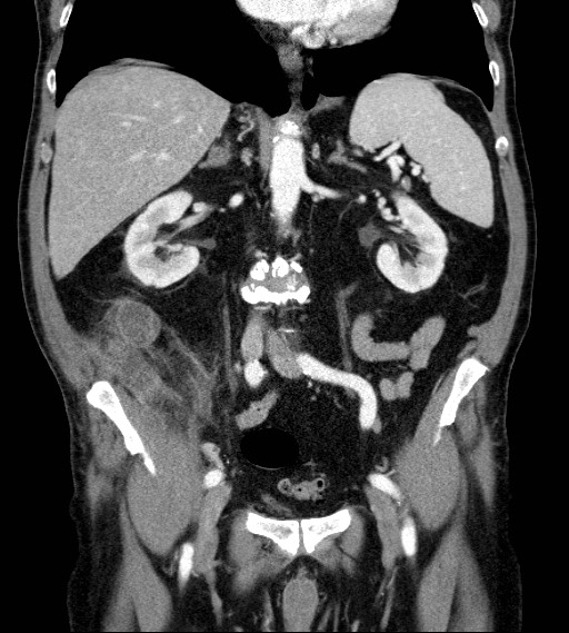 File:Appendiceal adenocarcinoma complicated by retroperitoneal abscess (Radiopaedia 58007-65039 A 45).jpg