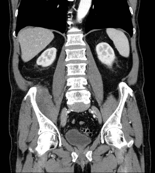 Appendiceal adenocarcinoma complicated by retroperitoneal abscess (Radiopaedia 58007-65039 A 57).jpg