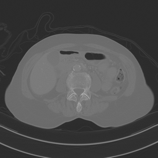 April fools' 2019- calcified peritoneal arachnoidosis (Radiopaedia 67273-76636 Axial bone window 21).png