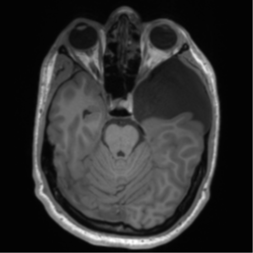 File:Arachnoid cyst with subdural hematoma (Radiopaedia 85892-101743 Axial T1 33).png