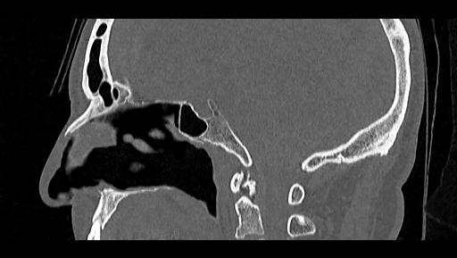 Arcuate foramen (Radiopaedia 89833-106944 Sagittal bone window 49).jpg