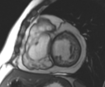 File:Arrhythmogenic right ventricular cardiomyopathy (Radiopaedia 69431-79307 Short axis cine 121).jpg