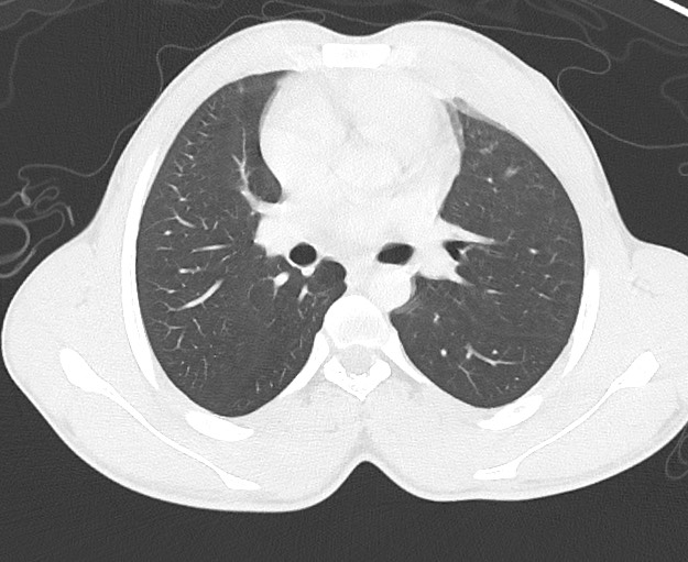 Arrow injury to the chest (Radiopaedia 75223-86321 Axial lung window 33).jpg