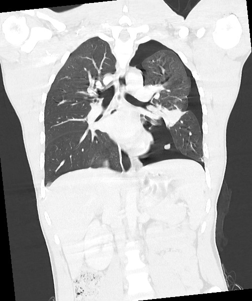 Arrow injury to the chest (Radiopaedia 85367-100975 Coronal lung window 80).jpg