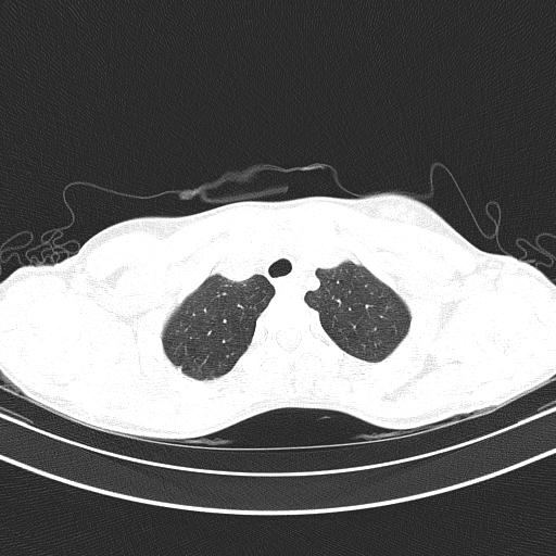 Arteria lusoria (Radiopaedia 88528-105192 Axial lung window 13).jpg