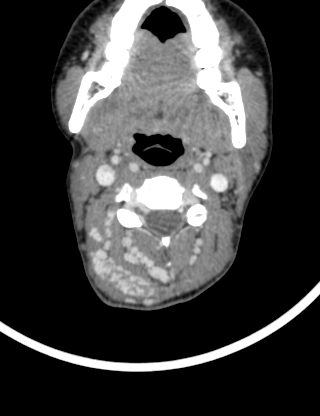 Arteriovenous malformation of the neck (Radiopaedia 53935-60062 B 17).jpg