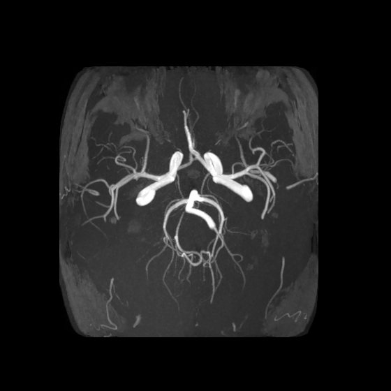 Artery of Percheron infarct (Radiopaedia 40966-43676 F 32).jpg