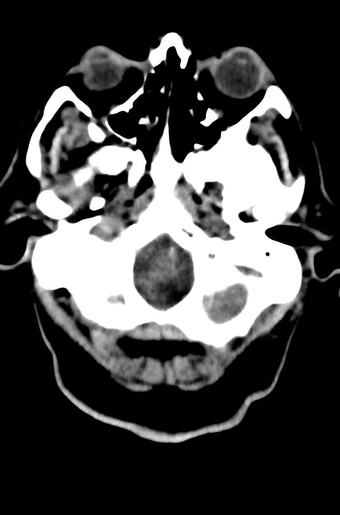 Artery of Percheron infarction (Radiopaedia 80613-94202 Axial non-contrast 33).jpg