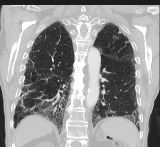 File:Asbestosis (Radiopaedia 56192-62864 Coronal lung window 37).png