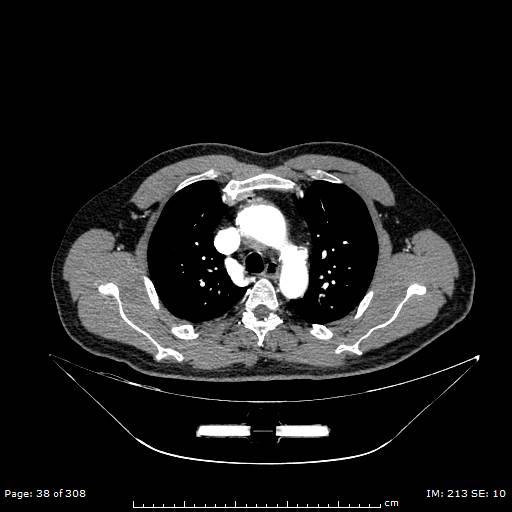 Ascending aortic aneurysm (Radiopaedia 50086-55404 A 13).jpg