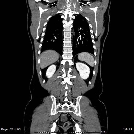 File:Ascending aortic aneurysm (Radiopaedia 50086-55404 B 55).jpg