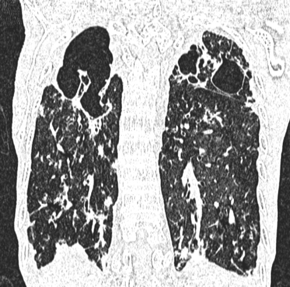Aspergilloma- with Monod sign (Radiopaedia 44737-48532 Coronal lung window 340).jpg