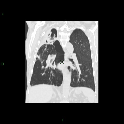 File:Aspergilloma (Radiopaedia 14842-14787 Coronal lung window 22).jpg