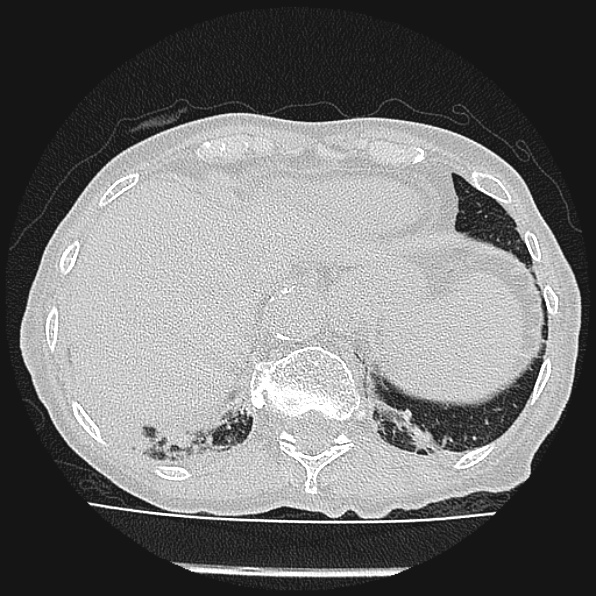 Aspergilloma (Radiopaedia 24458-24763 Axial lung window 60).jpg