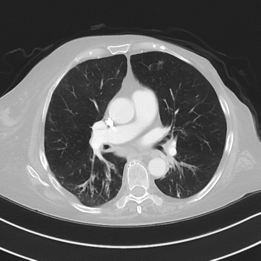 Aspiration bronchiolitis (Radiopaedia 53464-59463 Axial lung window 28).png