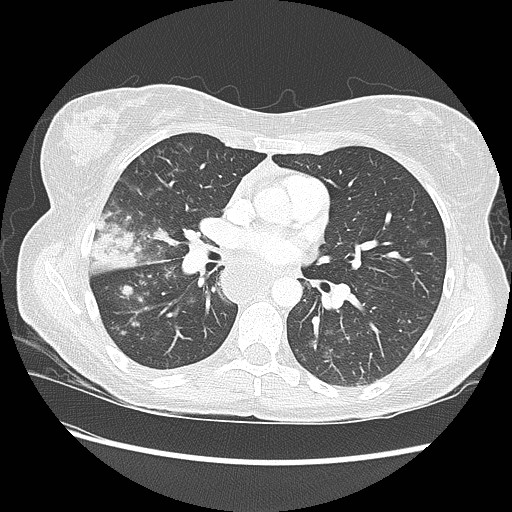 Aspiration pneumonia secondary to laparoscopic banding (Radiopaedia 18345-18183 lung window 54).jpg