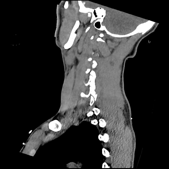Atlanto-occipital dissociation (Traynelis type 1), C2 teardrop fracture, C6-7 facet joint dislocation (Radiopaedia 87655-104061 D 61).jpg