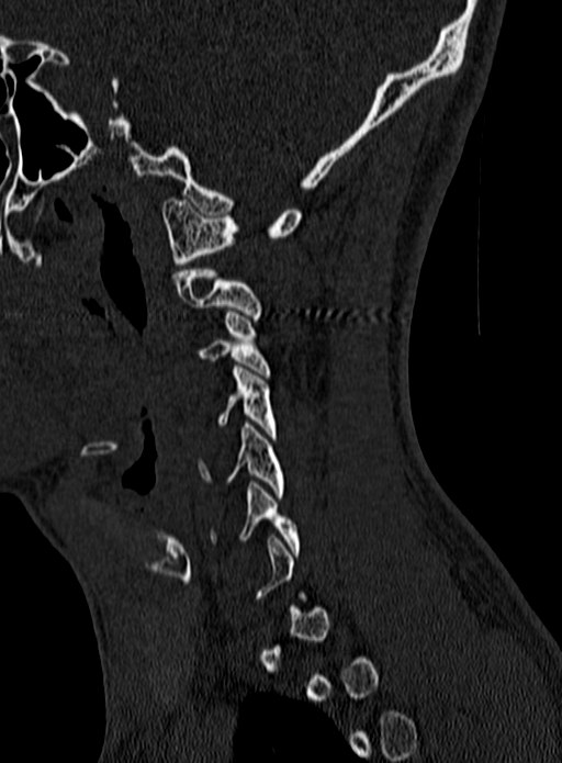 Atlantoaxial subluxation (Radiopaedia 44681-48450 Sagittal bone window 6).jpg