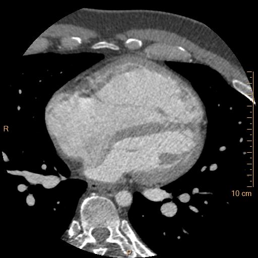 File:Atrial septal defect (upper sinus venosus type) with partial anomalous pulmonary venous return into superior vena cava (Radiopaedia 73228-83961 A 158).jpg