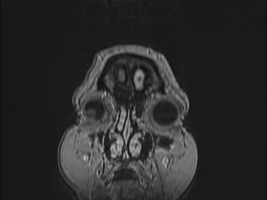 Atypical meningioma (Radiopaedia 62985-71406 Coronal T1 C+ 1).jpg