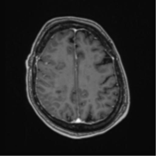 Atypical meningioma (WHO Grade II) (Radiopaedia 54742-60981 Axial T1 C+ 51).png