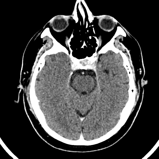 File:Atypical meningioma (WHO grade II) with brain invasion (Radiopaedia 57767-64728 Axial C+ 38).png
