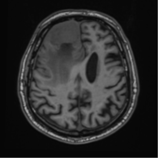 File:Atypical meningioma (WHO grade II) with brain invasion (Radiopaedia 57767-64729 Axial T1 36).png