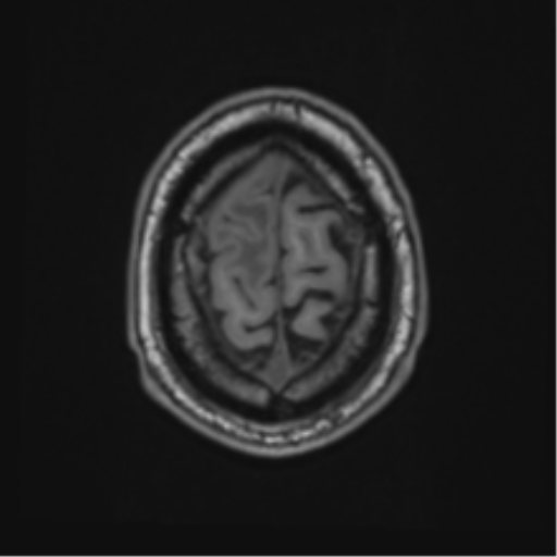 File:Atypical meningioma (WHO grade II) with brain invasion (Radiopaedia 57767-64729 Axial T1 47).png