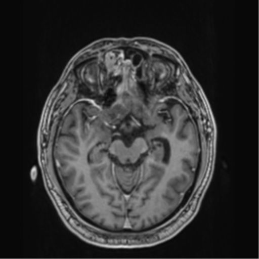 File:Atypical meningioma (WHO grade II) with brain invasion (Radiopaedia 57767-64729 Axial T1 C+ 19).png