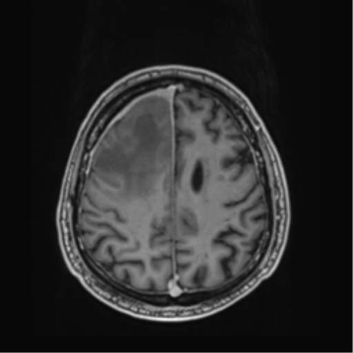 Atypical meningioma (WHO grade II) with brain invasion (Radiopaedia 57767-64729 Axial T1 C+ 36).png