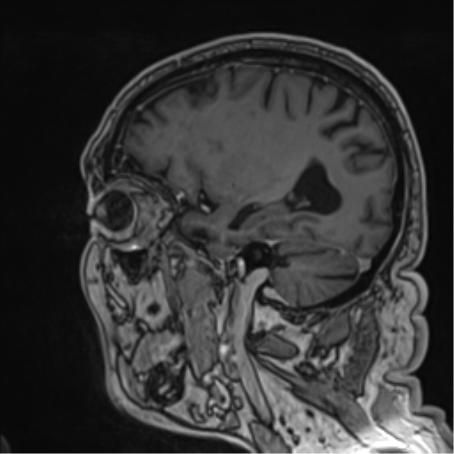 File:Atypical meningioma (WHO grade II) with brain invasion (Radiopaedia 57767-64729 Sagittal T1 C+ 25).png