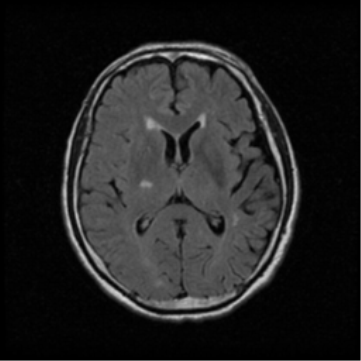 File:Atypical meningioma with skull invasion (Radiopaedia 34357-35648 Axial FLAIR 12).png