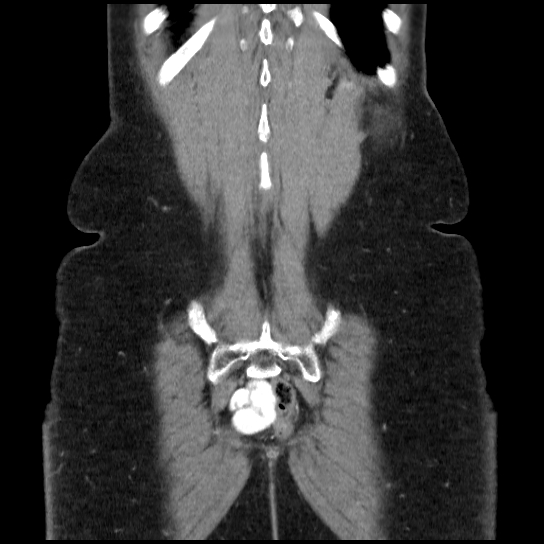 File:Atypical renal cyst (Radiopaedia 17536-17251 C 2).jpg