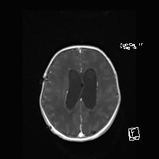 Atypical teratoid rhabdoid tumor (prenatal US and neonatal MRI) (Radiopaedia 59091-66388 Axial T1 C+ 42).jpg