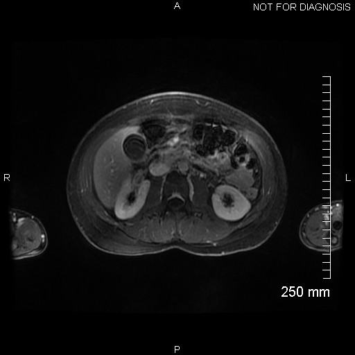 Autoimmune pancreatitis (Radiopaedia 88443-105101 A 80).jpg