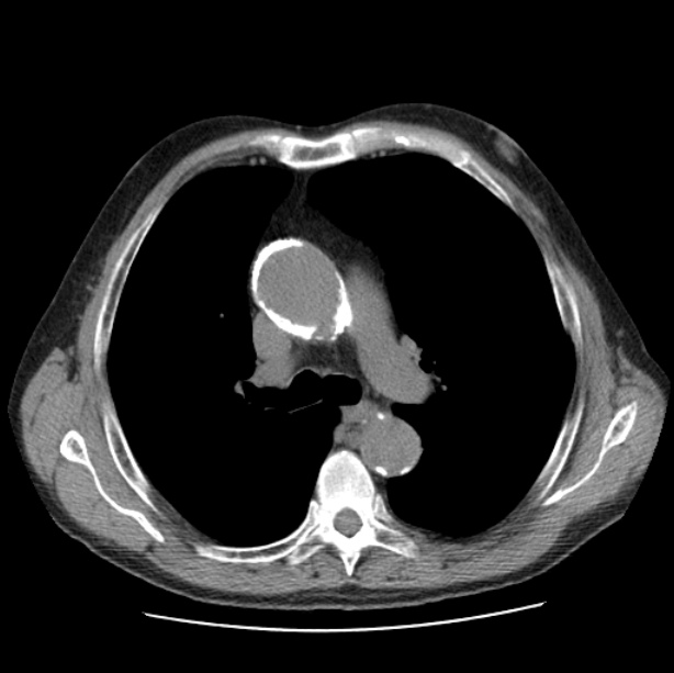 Autosomal dominant polycystic kidney disease (Radiopaedia 27851-28094 Axial non-contrast 22).jpg