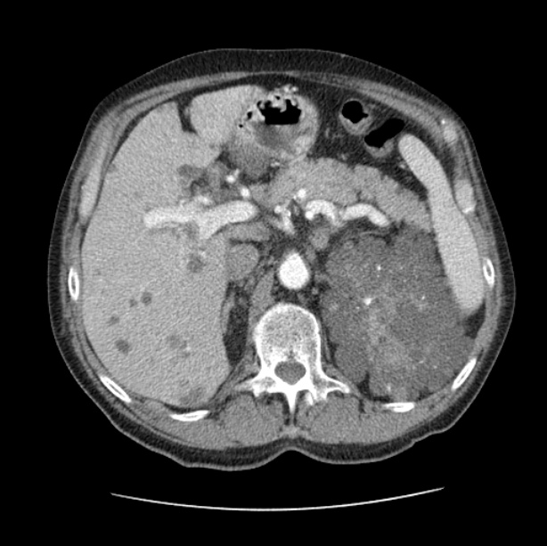 Autosomal dominant polycystic kidney disease (Radiopaedia 27851-28094 B 62).jpg
