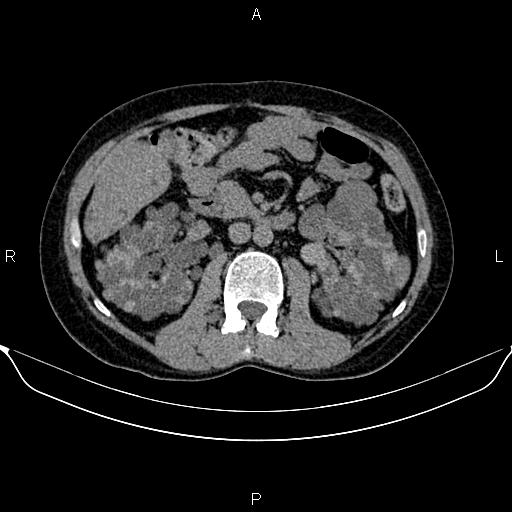 Autosomal dominant polycystic kidney disease (Radiopaedia 87830-104287 Axial non-contrast 25).jpg
