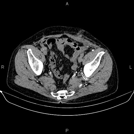 Autosomal dominant polycystic kidney disease (Radiopaedia 87830-104287 Axial non-contrast 48).jpg