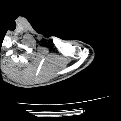 File:Avascular necrosis after fracture dislocations of the proximal humerus (Radiopaedia 88078-104655 D 26).jpg