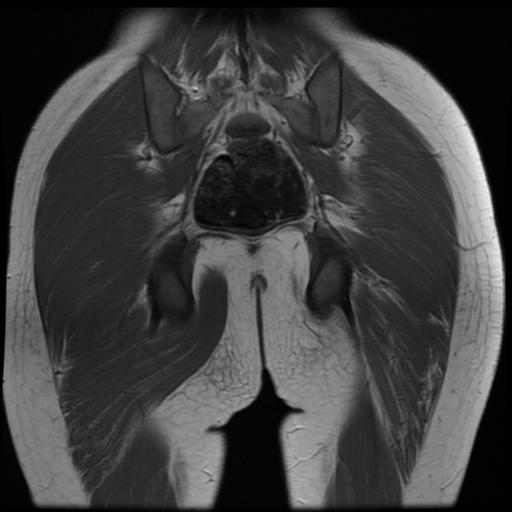 File:Avascular necrosis of the hip (Radiopaedia 29563-30067 Coronal T1 16).jpg
