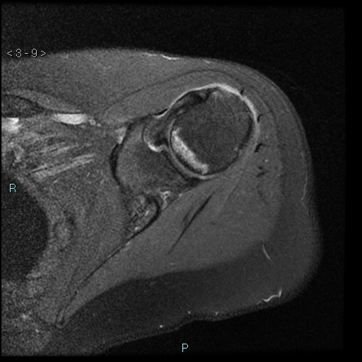 File:Avascular necrosis of the shoulder - Cruess stage I (Radiopaedia 77674-89886 Axial PD fat sat 9).jpg