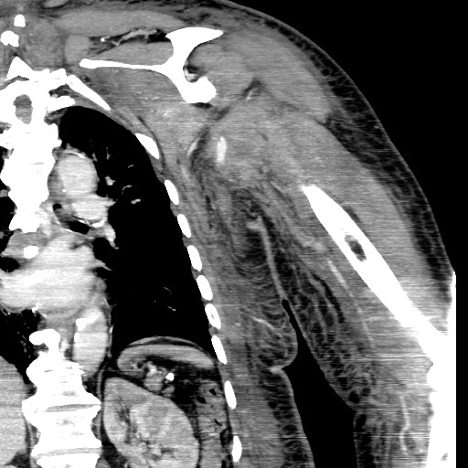 File:Axillary arterial pseudoaneurysm (Radiopaedia 24925-25195 B 14).jpg
