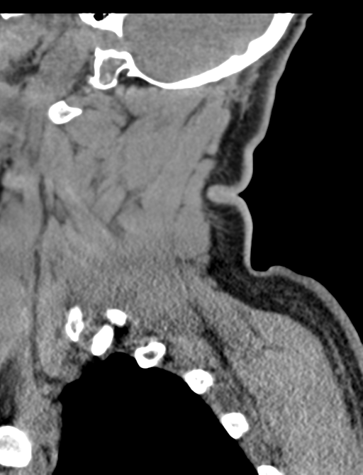 Axis peg fracture (type 3) and atlas lateral mass (type 4) fracture (Radiopaedia 37474-39324 D 15).png