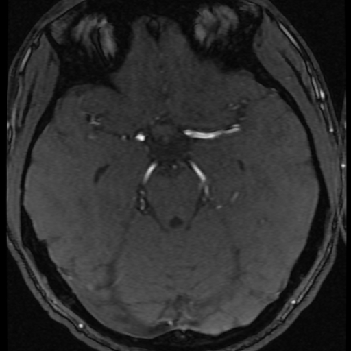 Azygos anterior cerebral artery (Radiopaedia 17059-16756 Axial MRA 44).jpg