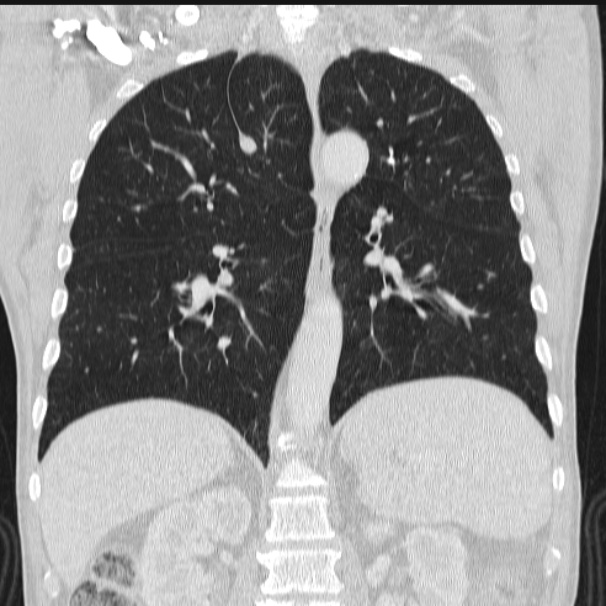 Azygos lobe (Radiopaedia 38259-40275 Coronal lung window 50).jpg